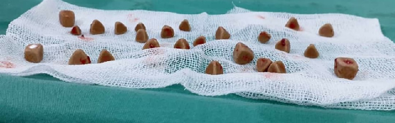 عملية ناجحة لمريض في العقد الثامن